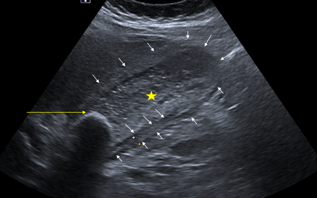 Cholecystitis