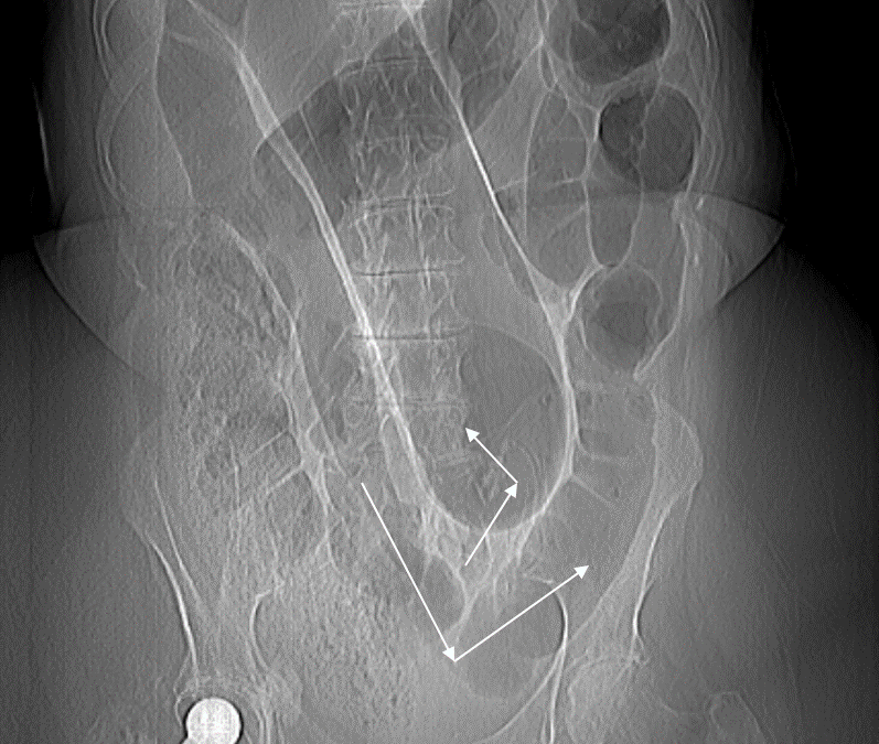 Twisted bowel (sigmoid volvulus)