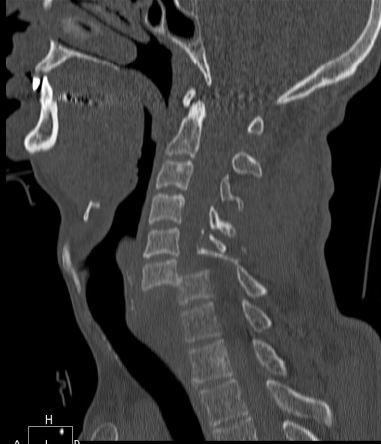 Stirbt Man Bei Einem Genickbruch Sofort Genickverletzung - International Day of Radiology